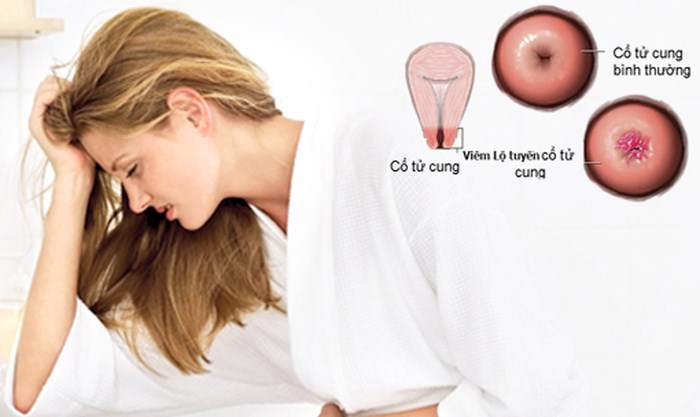 3 loại bệnh phụ khoa gần 90% phụ nữ mắc phải